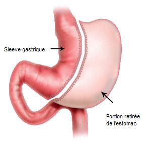 sleeve gastrectomie