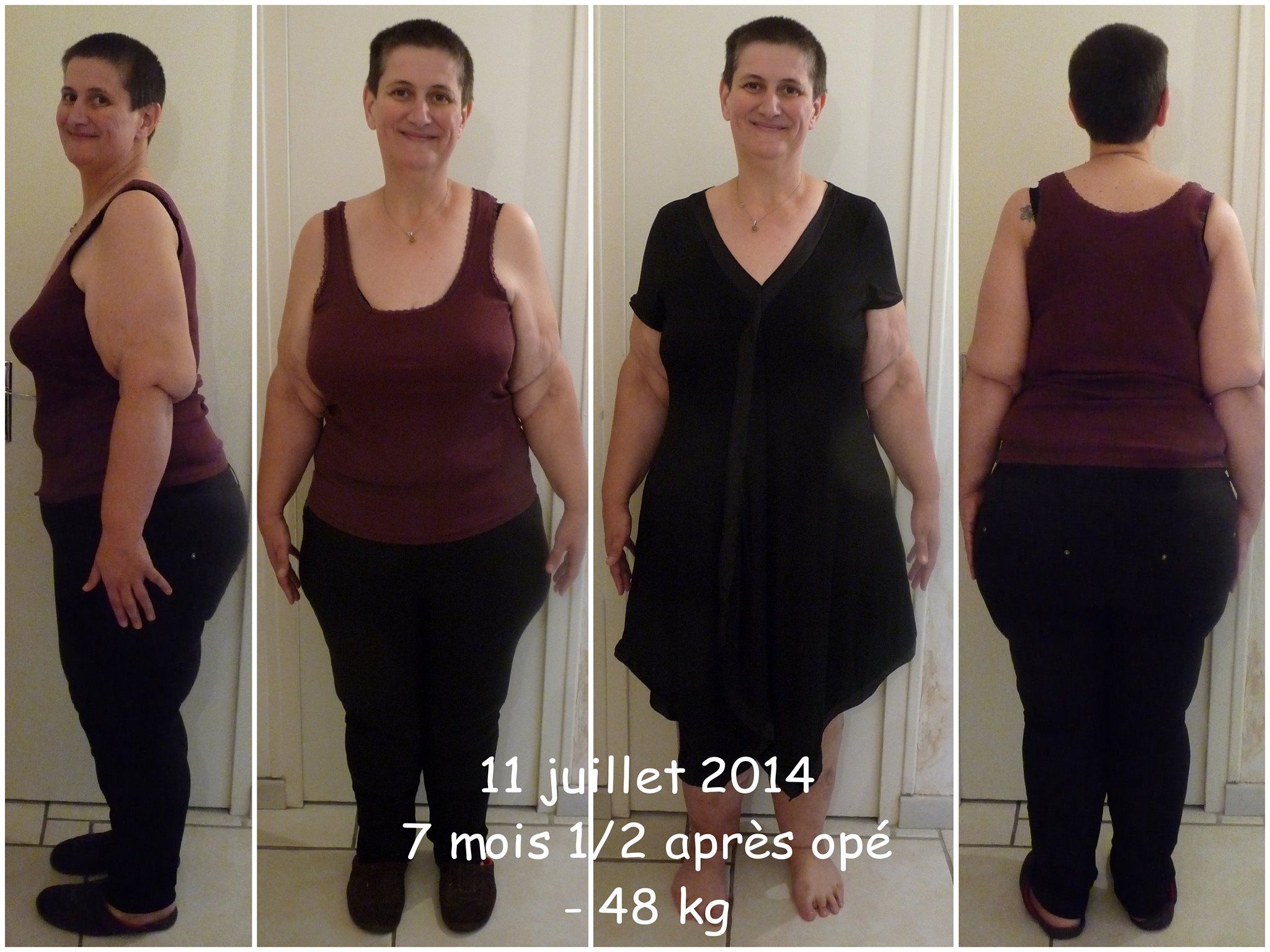 Bypass maigrir avant apres - Julie Gyorgak