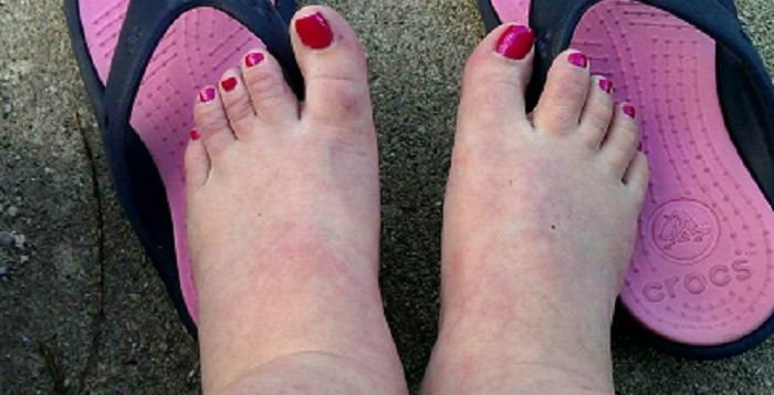 Soulager Les Pieds Gonfles Soulager Les Pieds Gonfles