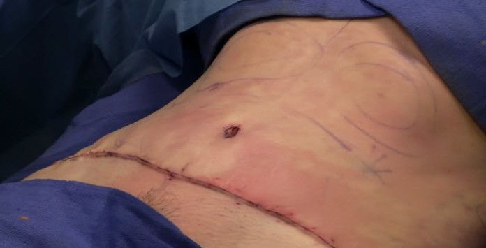 Stomach Vacuum Résultats En Combien De Temps Chirurgie réparatrice de l'obésité : le ventre