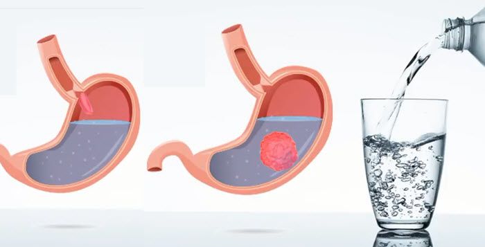 Minciball Notre Avis Sur La Pilule Qui Remplace La Chirurgie Bariatrique