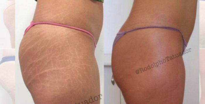 Faire Disparaître Les Vergetures En Les Tatouant La