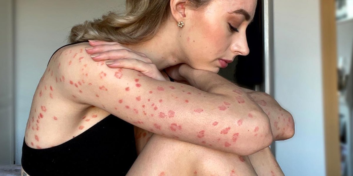 Vivre avec le psoriasis : ces femmes témoignent